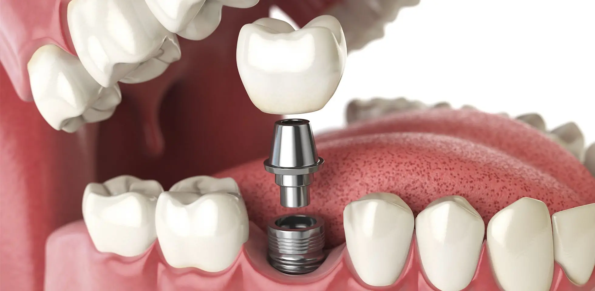 Dental implants