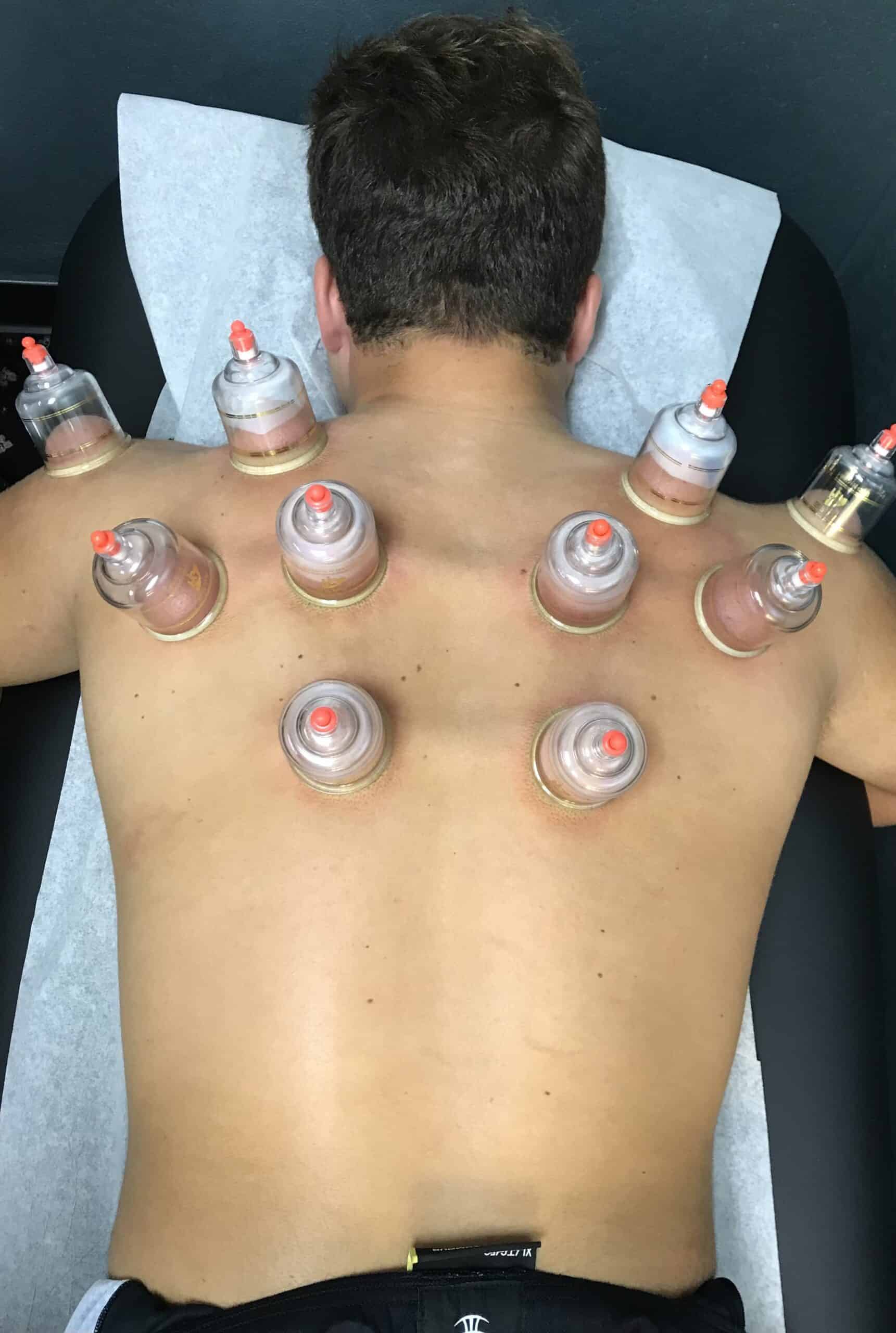 Acupuncture treatment at Asiana Wellness