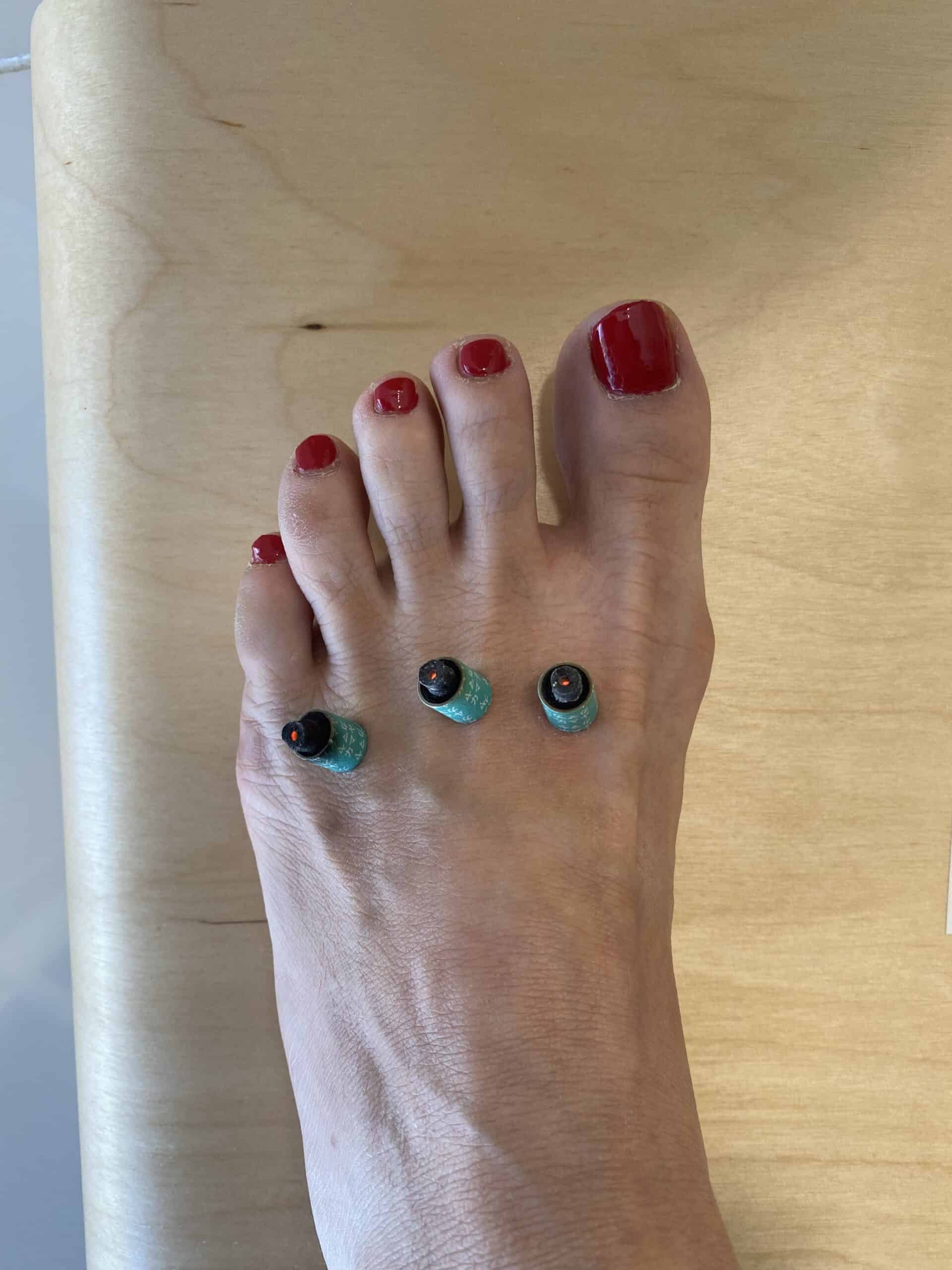 Acupuncture treatment