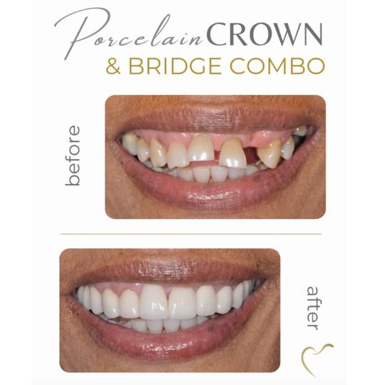 Porcelain veneers