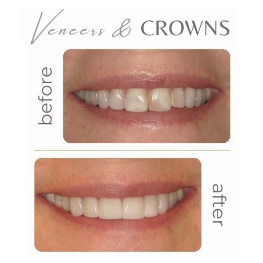 Beautiful smile makeover