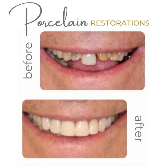 Clear aligners orthodontics