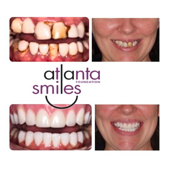 Facial aesthetics botox fillers