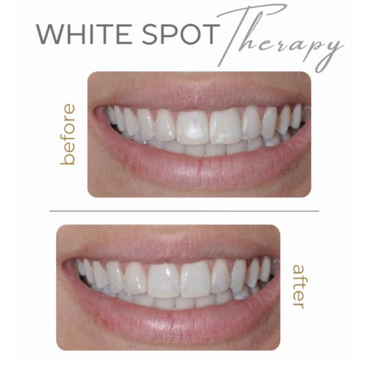 Smile transformation