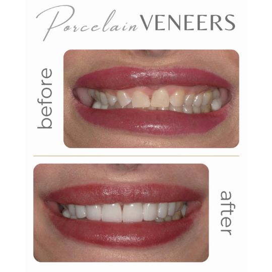 Cosmetic dentistry result