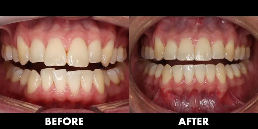 Before & After Treatment