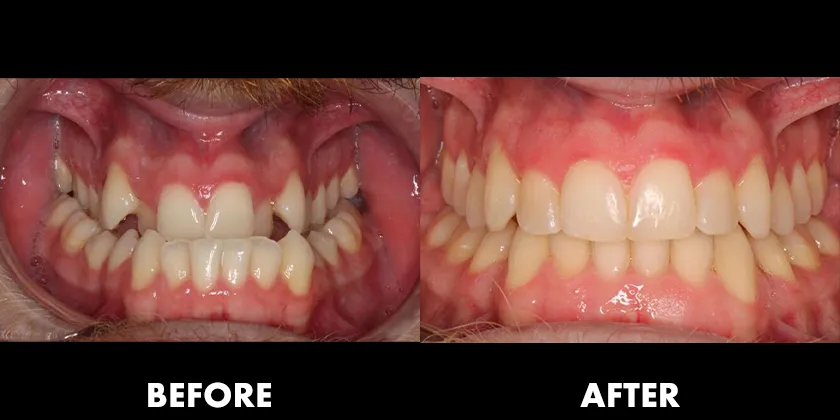 Before & After Orthodontic Treatment