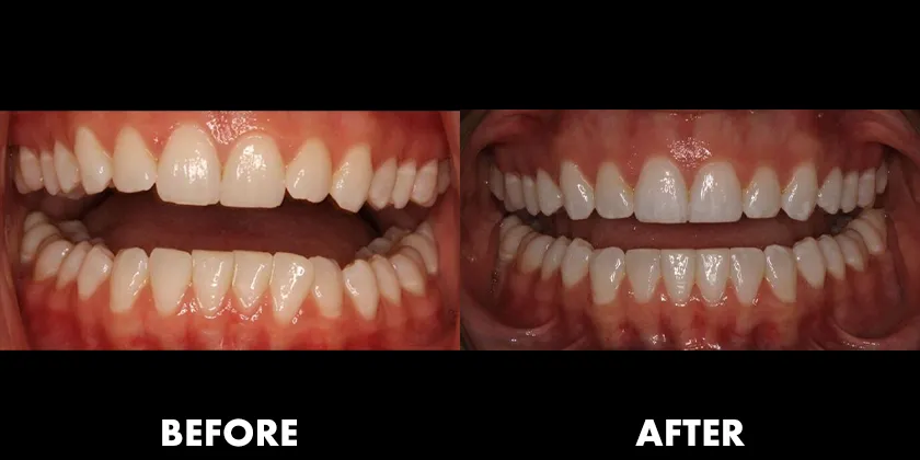 Before & After Treatment