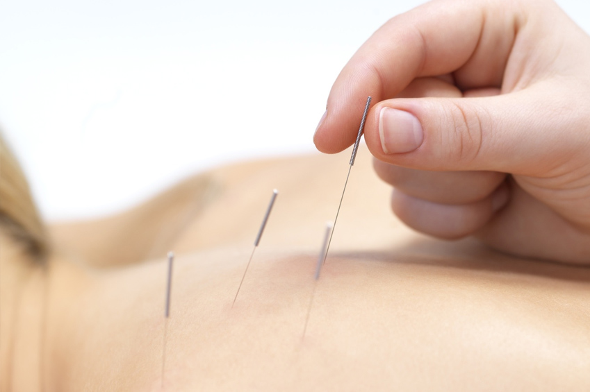 Sports Acupuncture