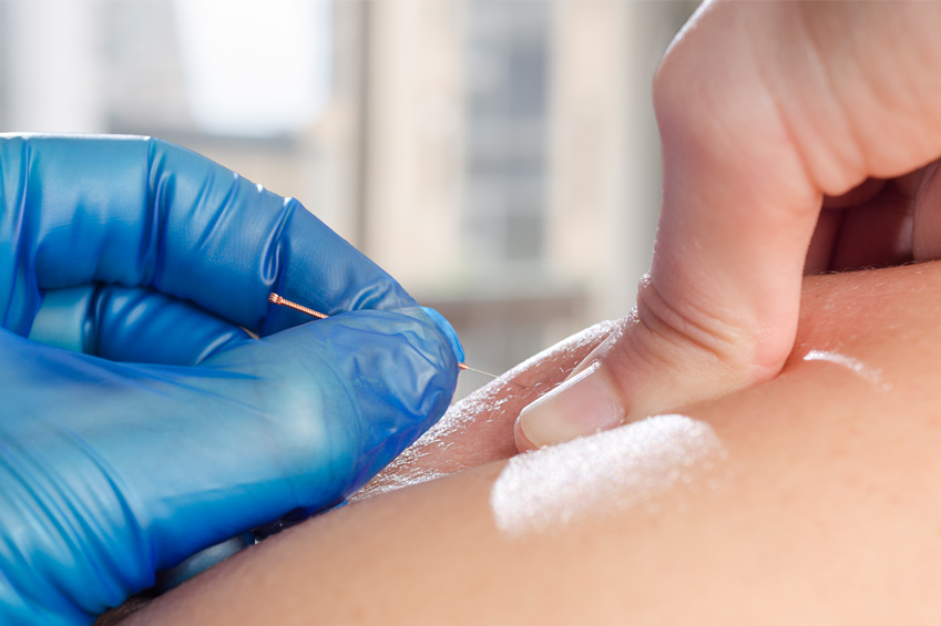 Trigger Point Dry Needling