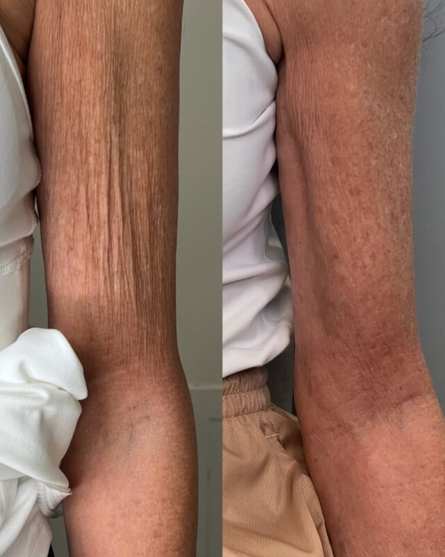 Endolaser Treatment Results