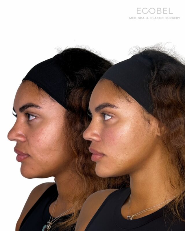 Cheek Filler Before and After