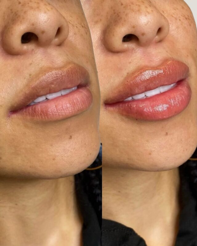 Lip Enhancement at Ecobel