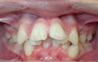 Before orthodontic treatment