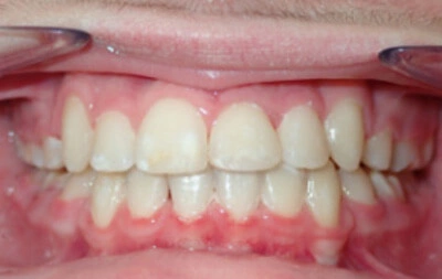 After orthodontic treatment