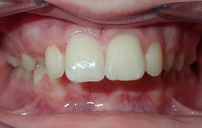 Before orthodontic treatment