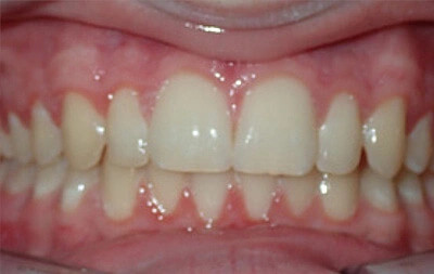 After orthodontic treatment