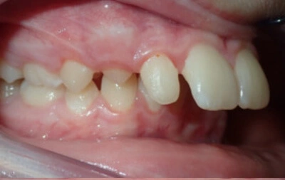Before orthodontic treatment