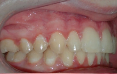 After orthodontic treatment