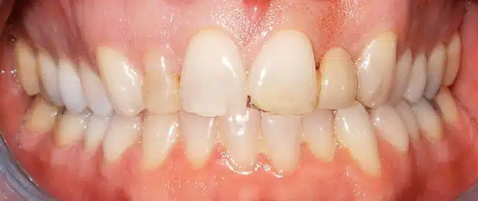 Dental implants Nashville