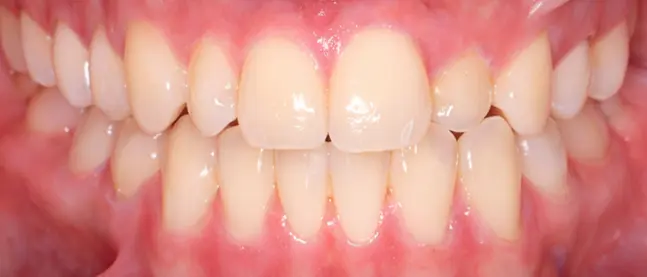 Before crossbite correction at Limestone Hills Orthodontics Austin