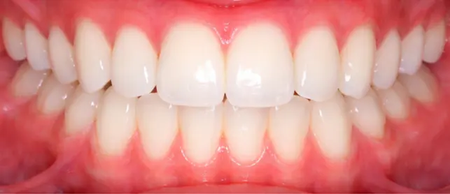 After crossbite correction at Limestone Hills Orthodontics Austin