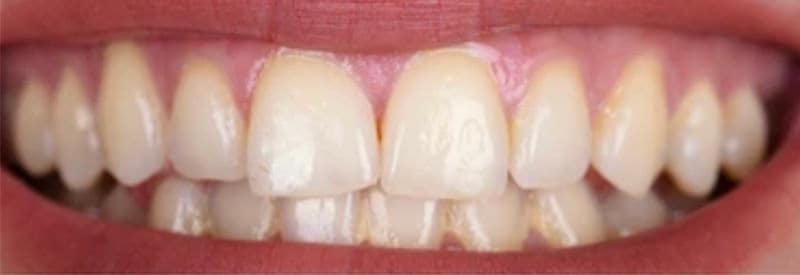 Teeth whitening before and after