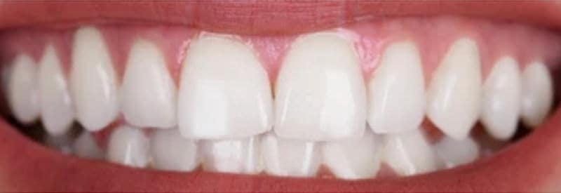 Teeth whitening transformation