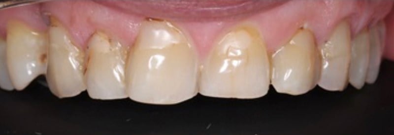 Porcelain veneers before and after