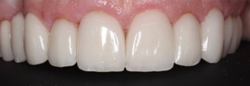 Porcelain veneers transformation