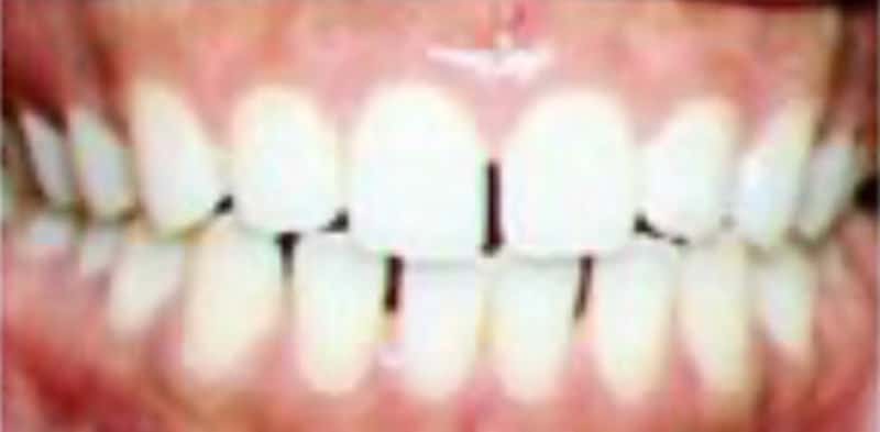 Clear aligner results