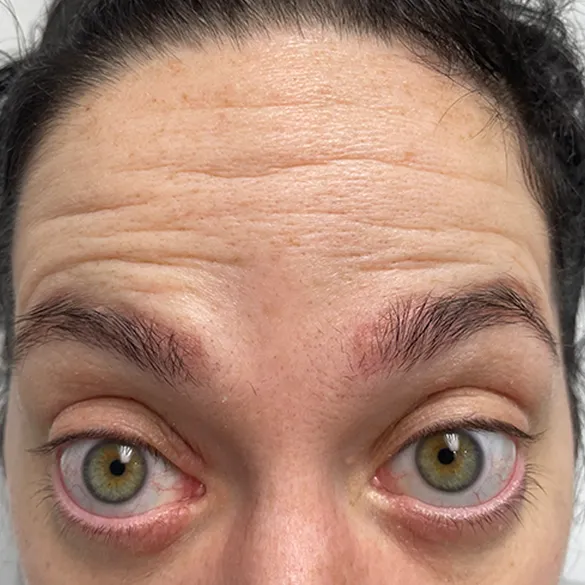 Botox before treatment