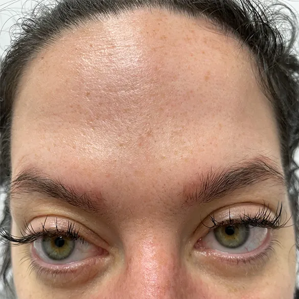 Botox after treatment
