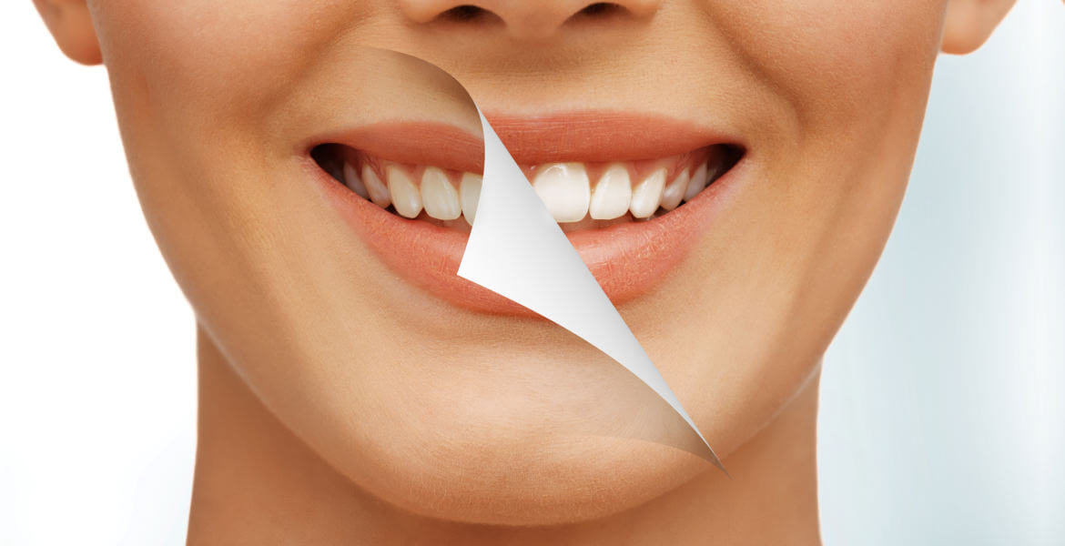 Zoom teeth whitening