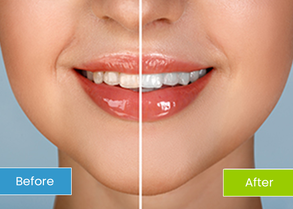 Before and after teeth whitening result
