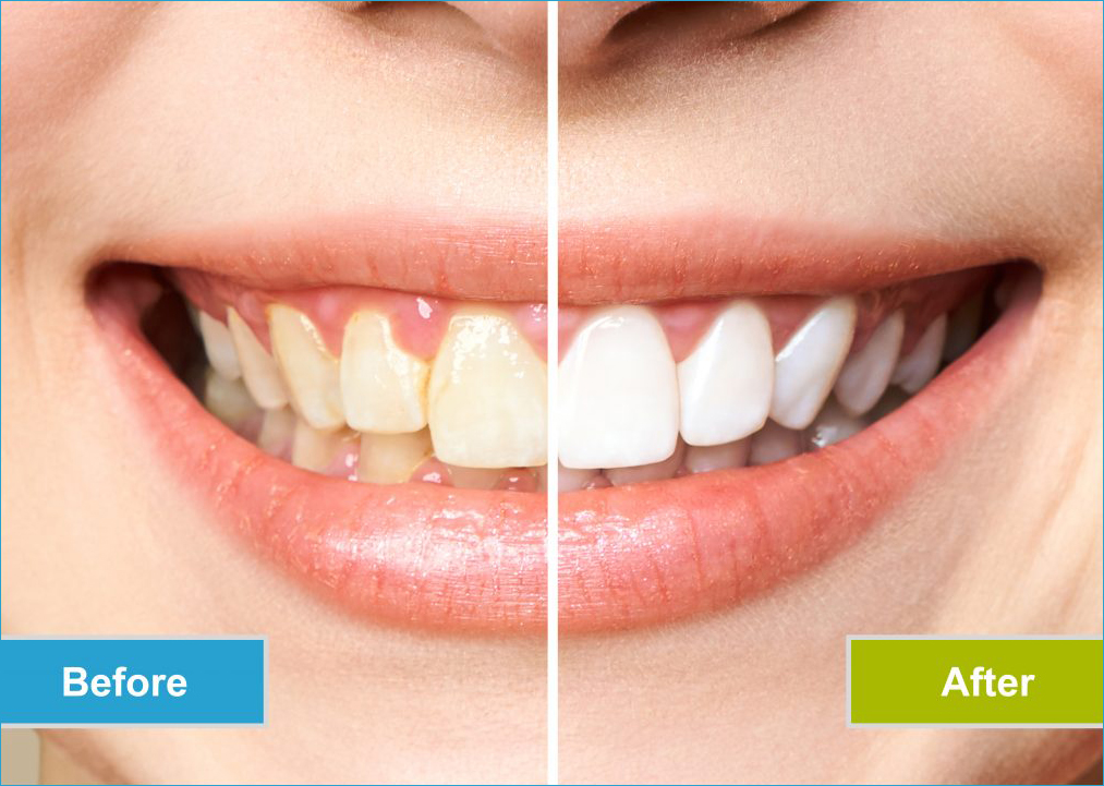 Teeth whitening before and after comparison