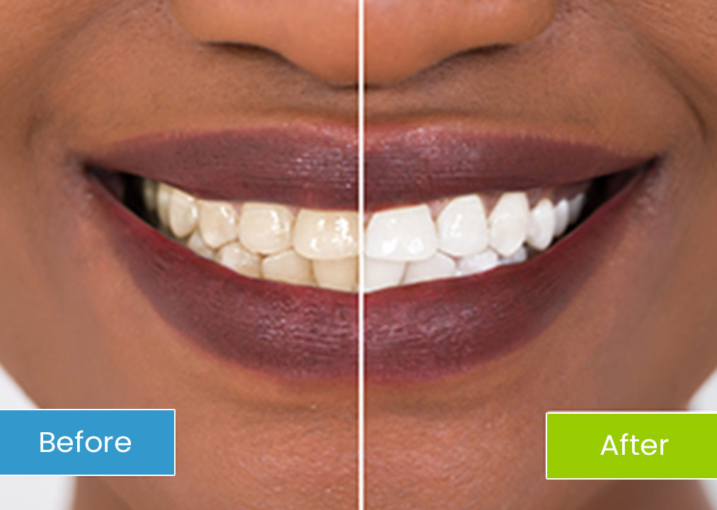 Before and after teeth whitening comparison