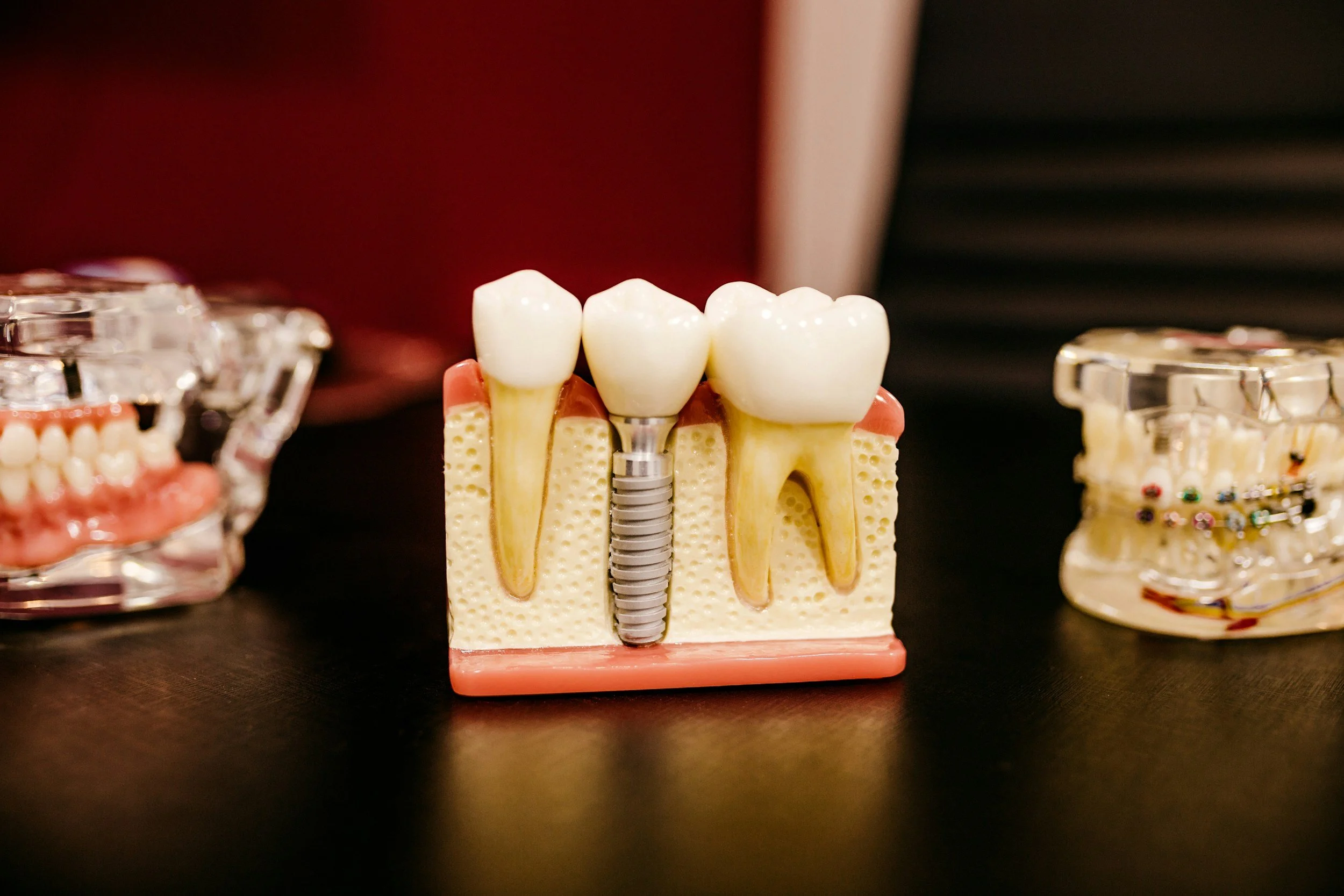 Dental implant model — Newport Beach Dental Associates