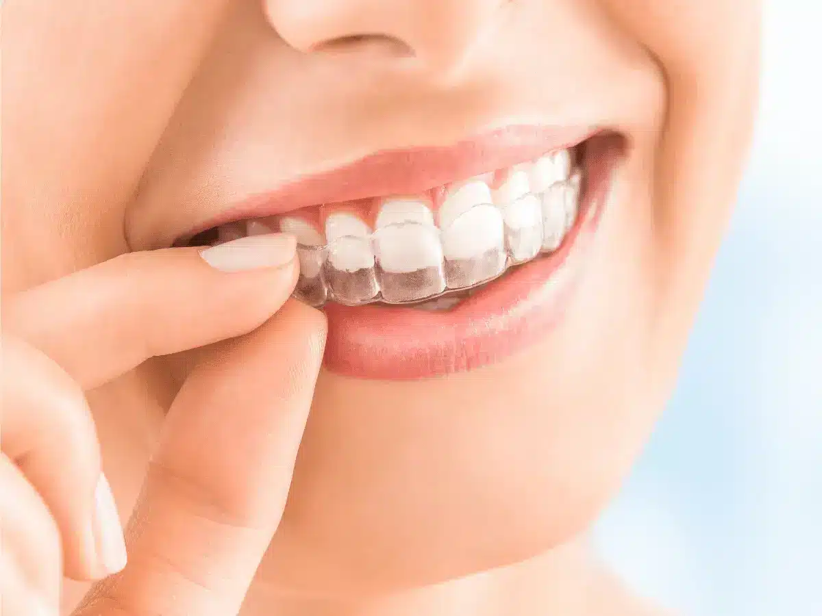 Invisalign Clear Aligners