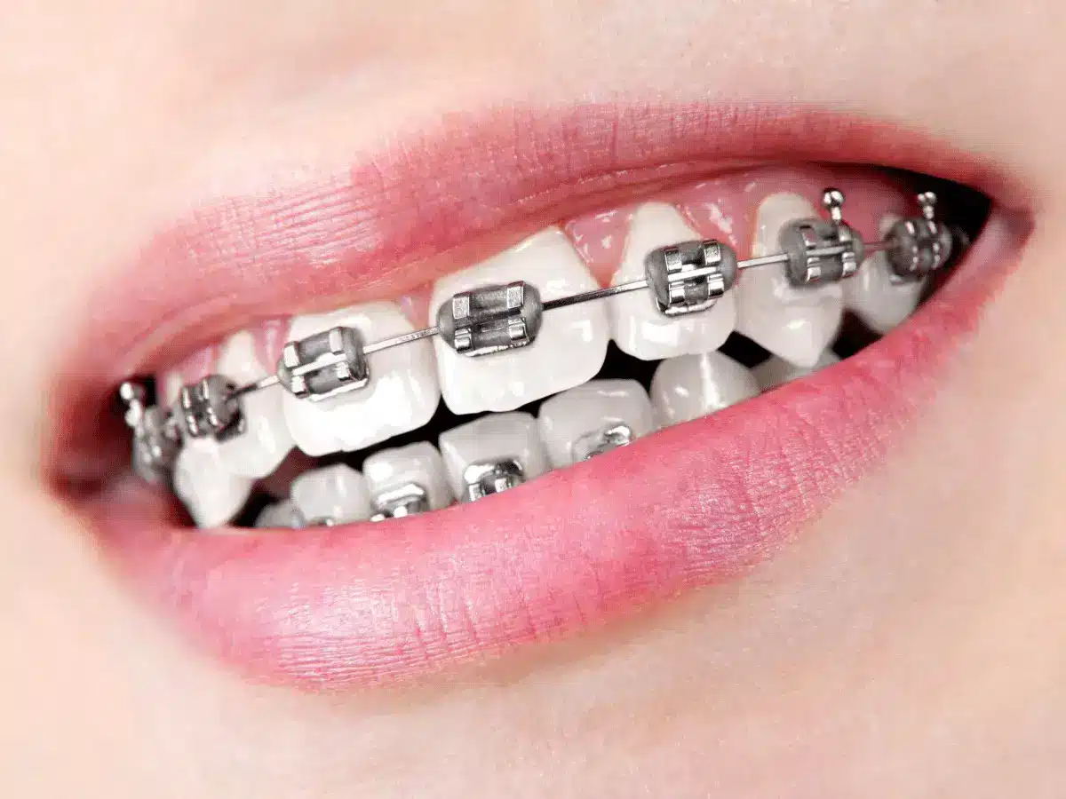 Traditional Braces