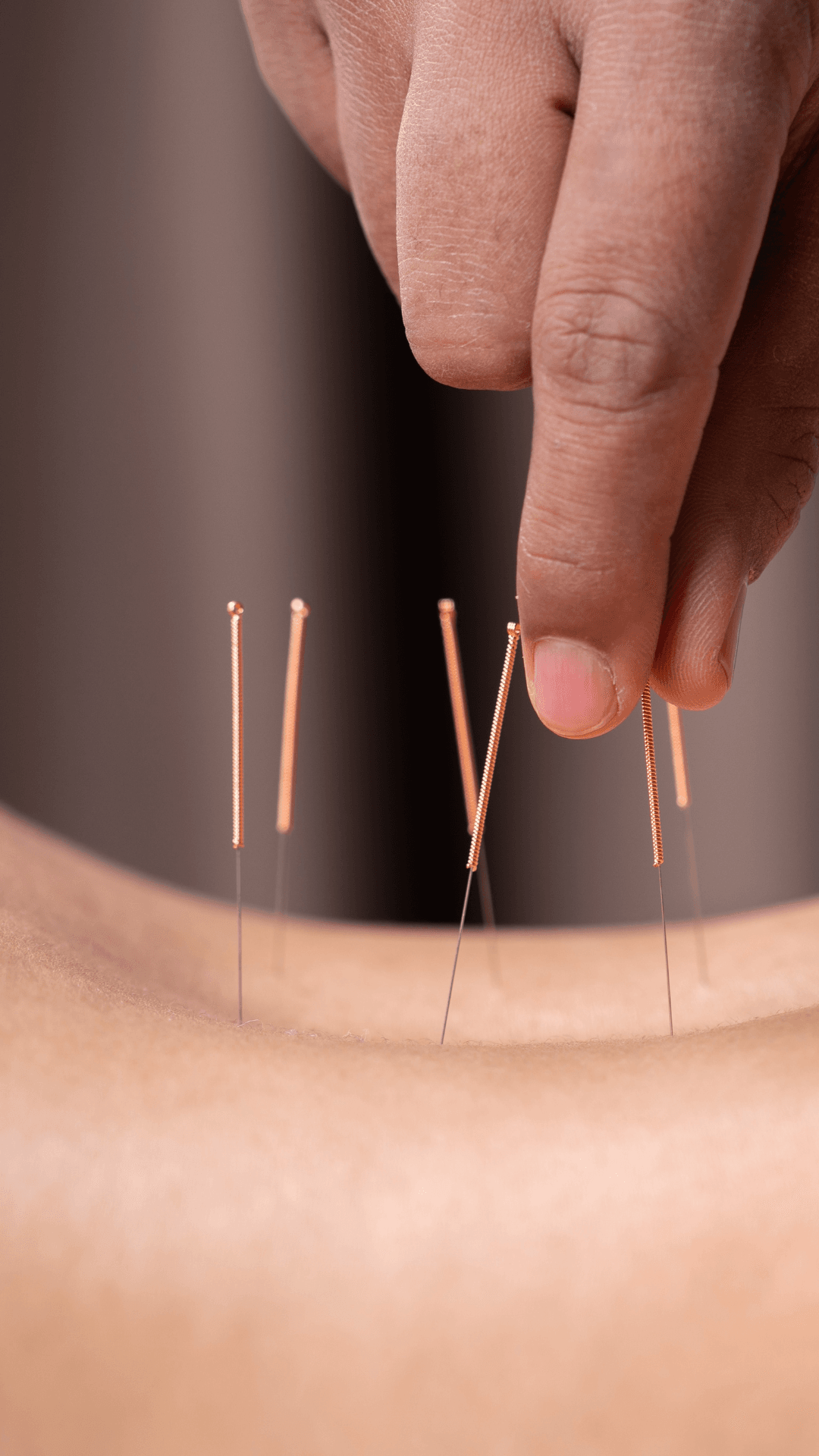 Sports medicine acupuncture treatment