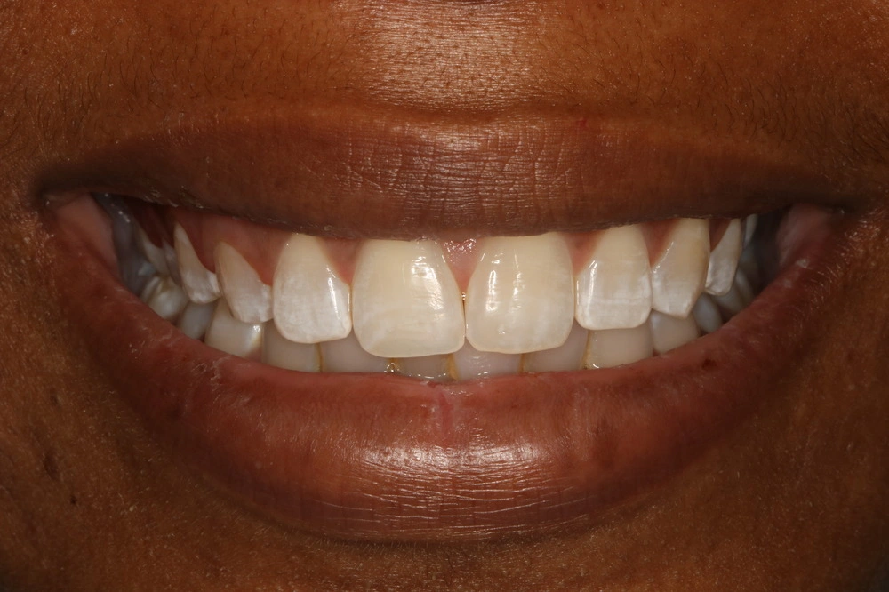 Before smile transformation