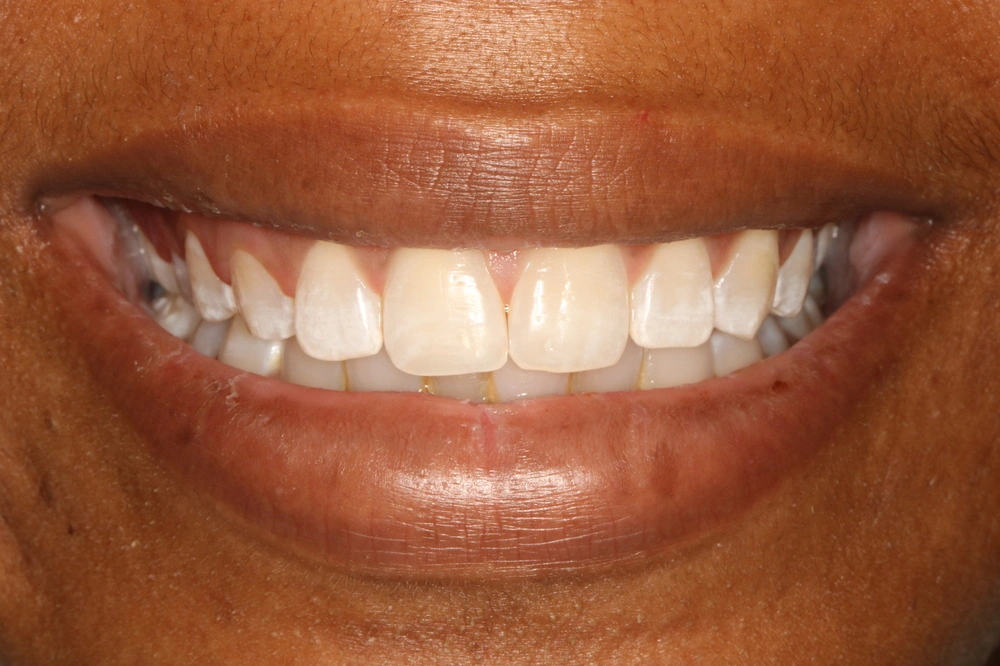 After smile transformation