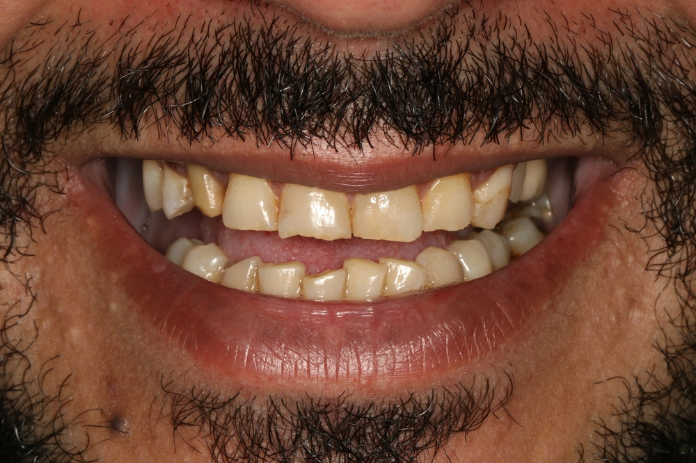 Before smile transformation 2